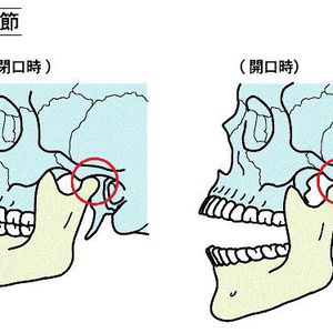 顎関節症と顎の痛み