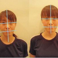 顔の歪み施術例（顔の非対称）